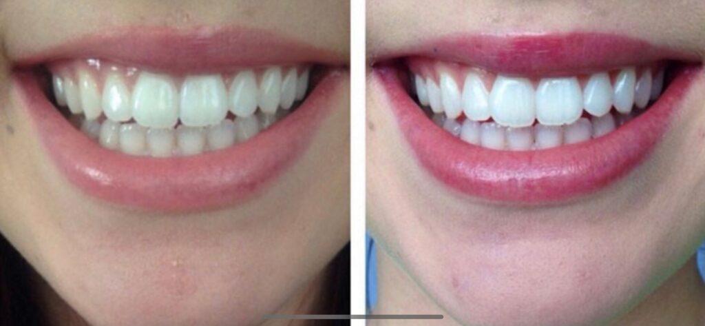 Teeth Whitening in Murrieta and Temecula
