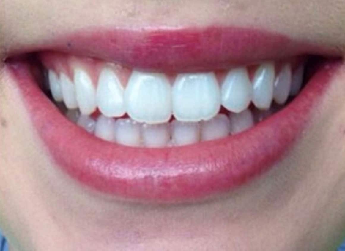 Teeth Whitening in Murrieta and Temecula
