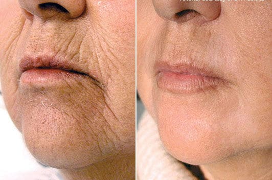 Fibroblast Plasma Service in Temecula and Murrieta