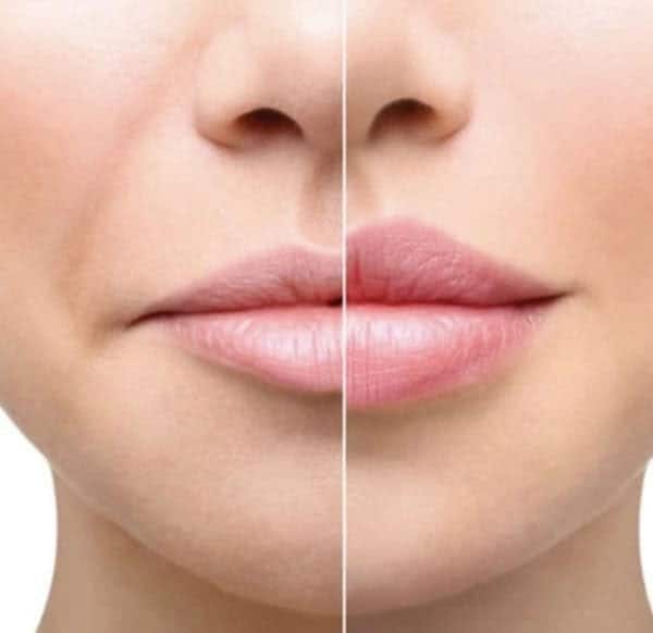 Hyaluron Pen Filler Treatment