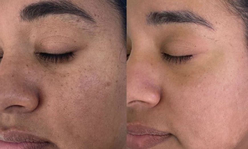 28A05161-A86B-47B9-B782-A00C5FDA6437 Fibroblast Plasma Service in Temecula and Murrieta