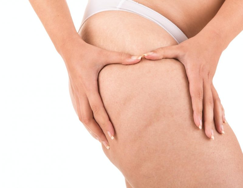 Woman showing her cellulite